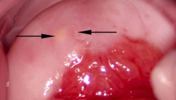 nabothian cyst in cervix