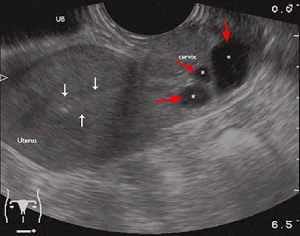 Endometrial Cysts On Ultrasound
