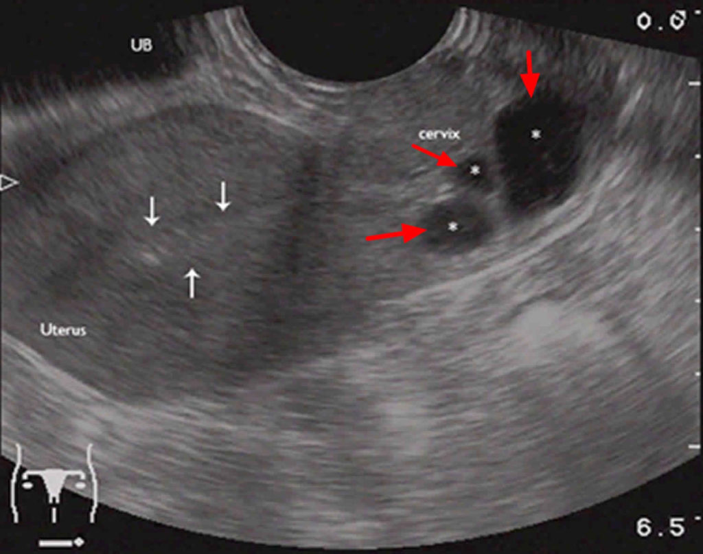 How Big Is 3 Cm Cyst