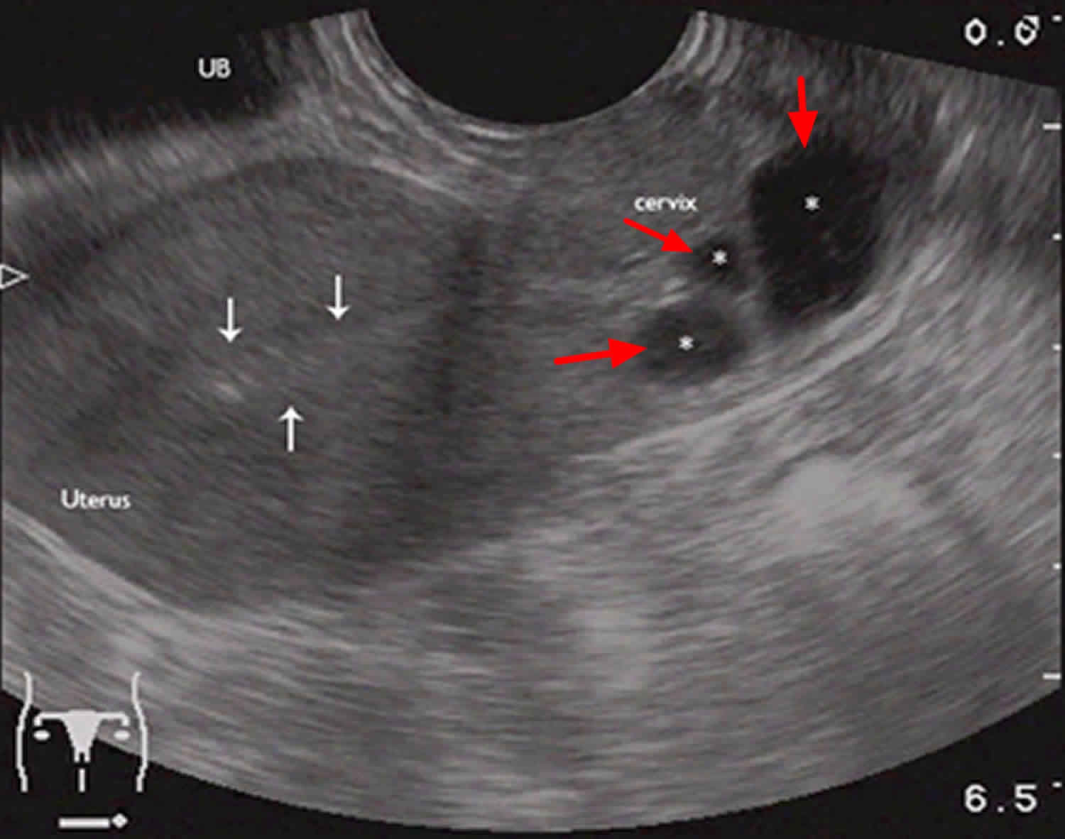 Cisto De Naboth é Endometriose - LIBRAIN