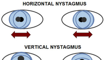 nystagmus