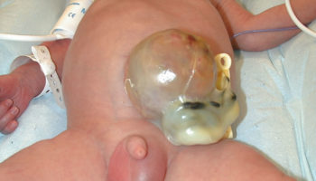 omphalocele