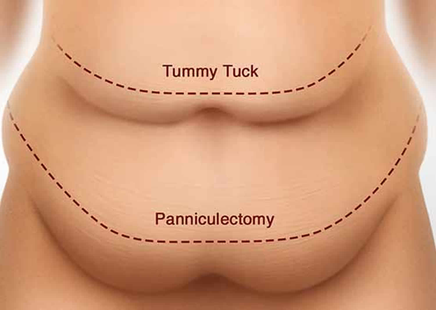 panniculectomy vs tummy tuck