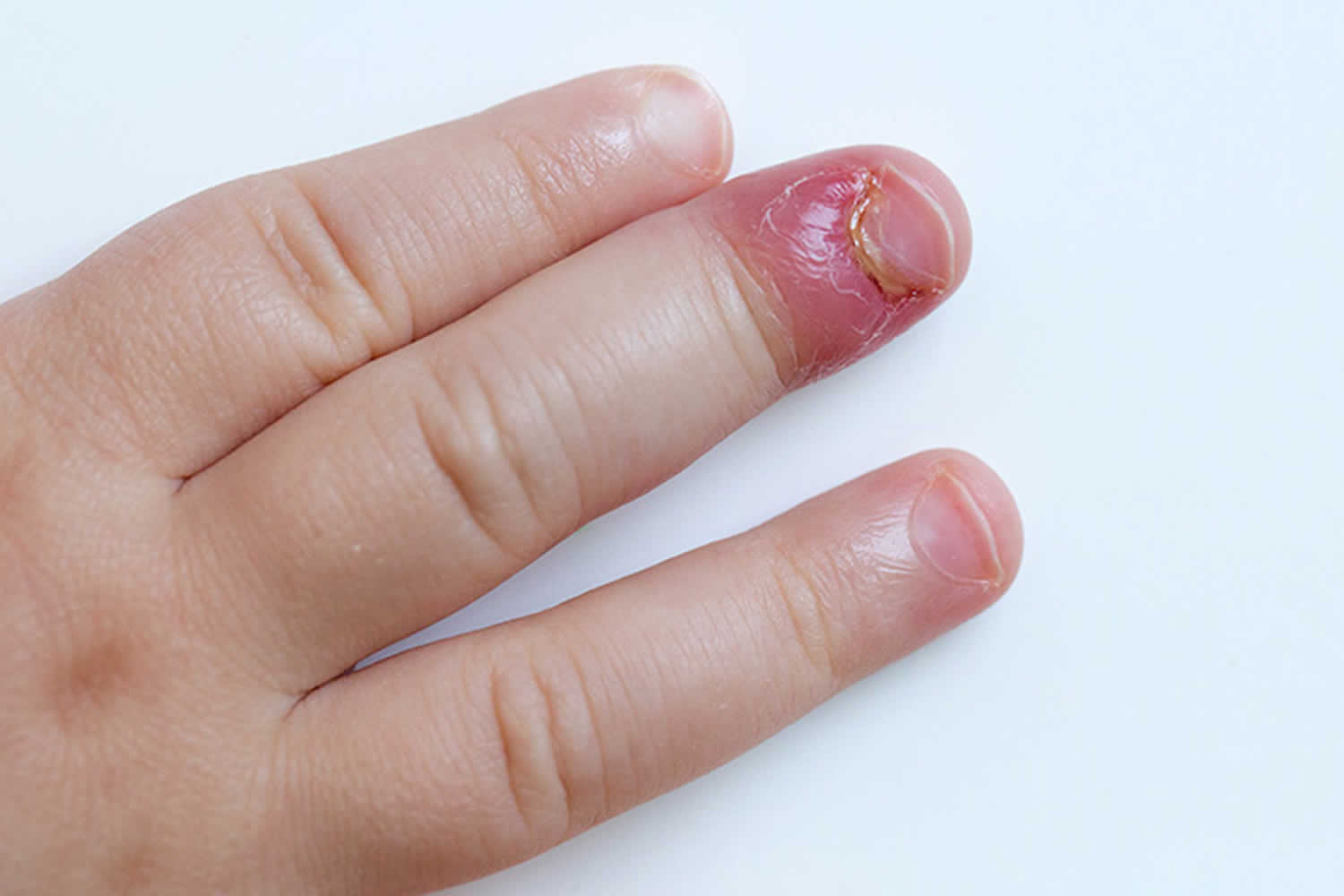 Nail Problem Nail Fold Infection Paronychia Stock Photo 771579253 |  Shutterstock
