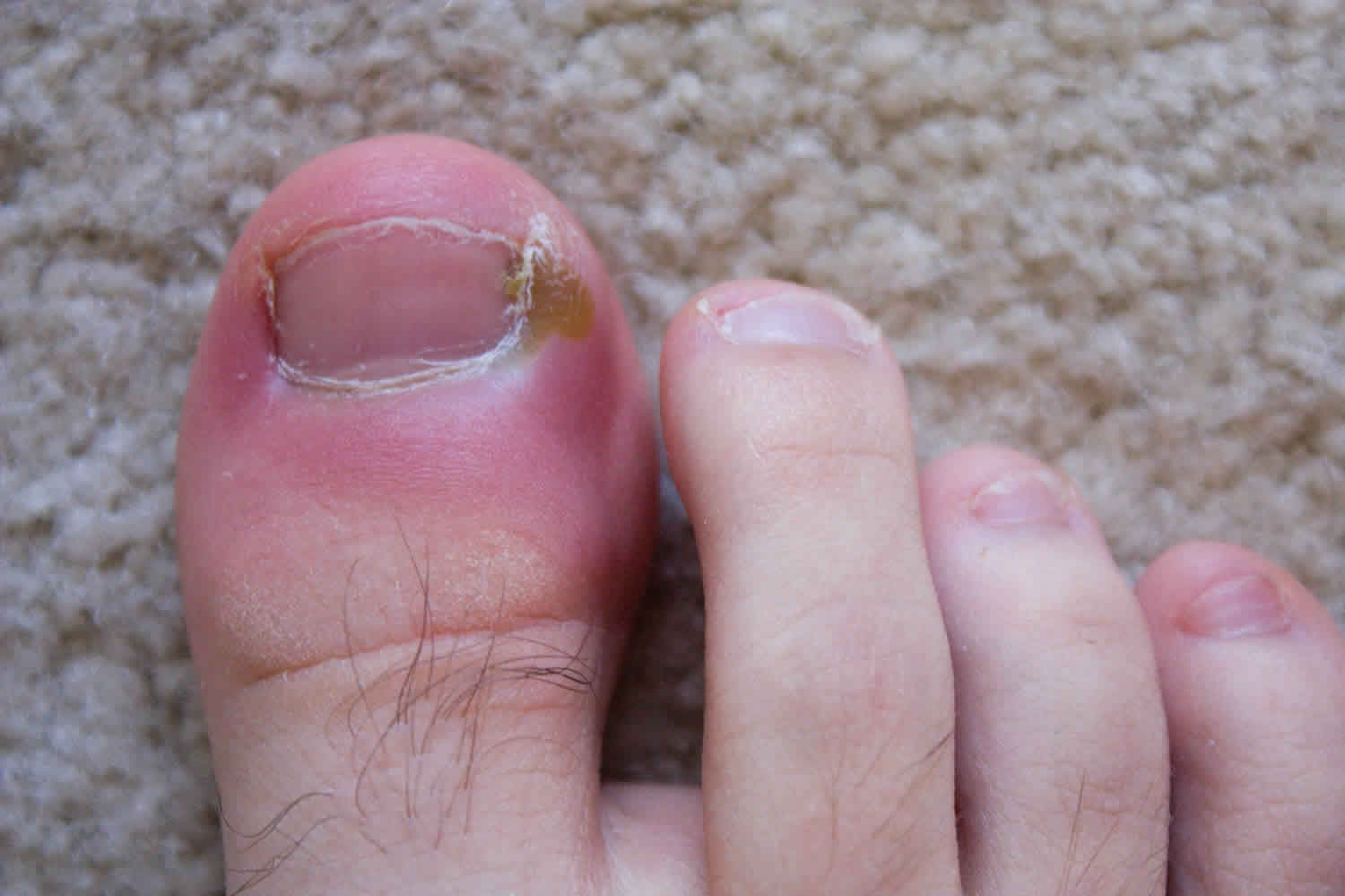 Paronychia Nail Infection - American Osteopathic College of Dermatology  (AOCD)