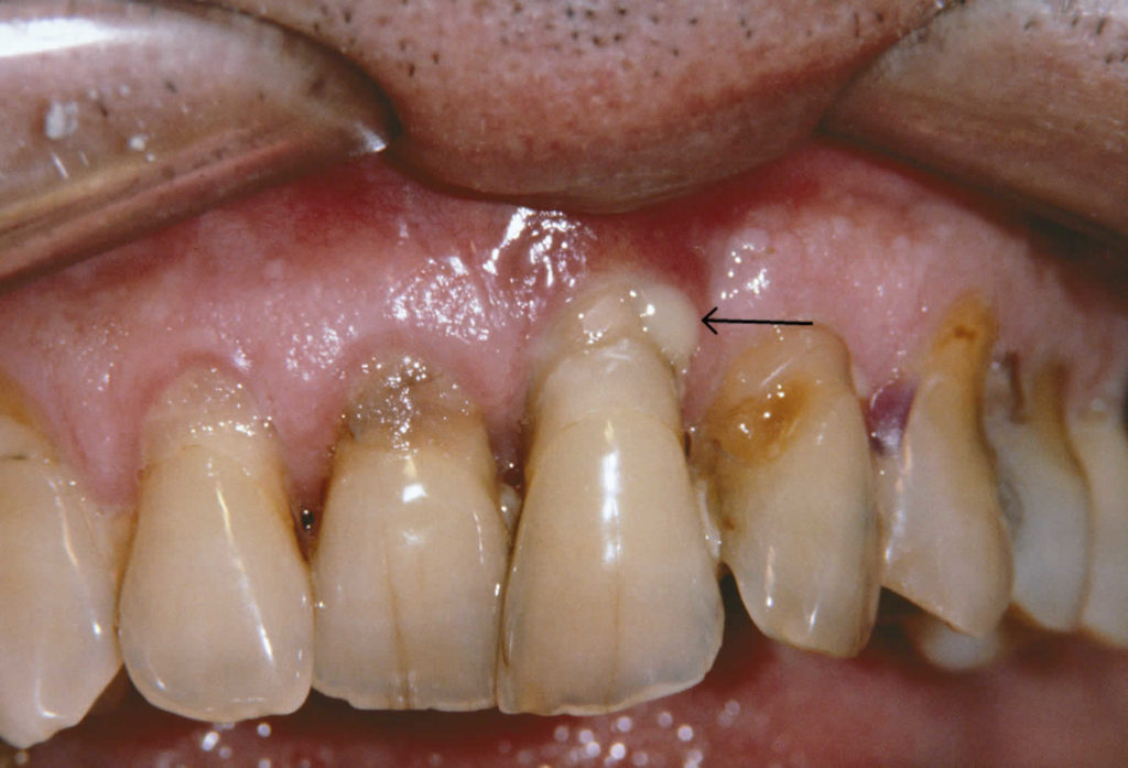 Periodontitis Causes, Symptoms, Complications, Diagnosis & Treatment