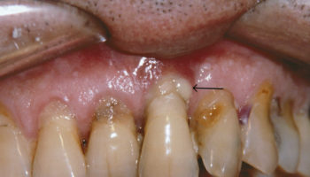 periodontitis