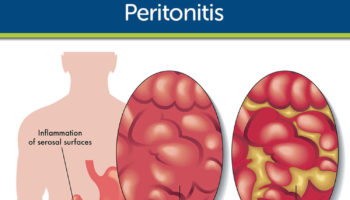 peritonitis