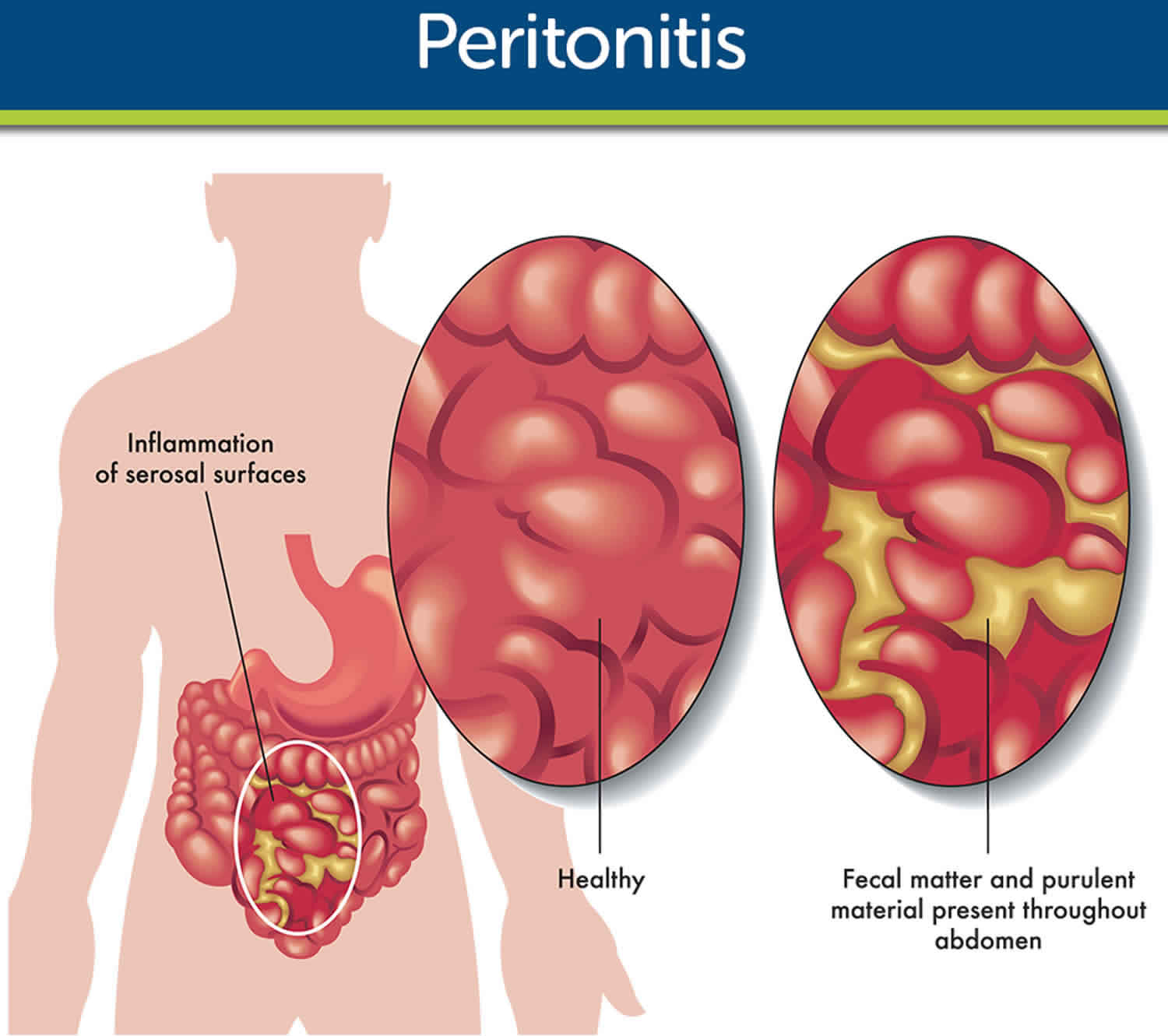 Acute Appendicitis With Localized Peritonitis Symptoms