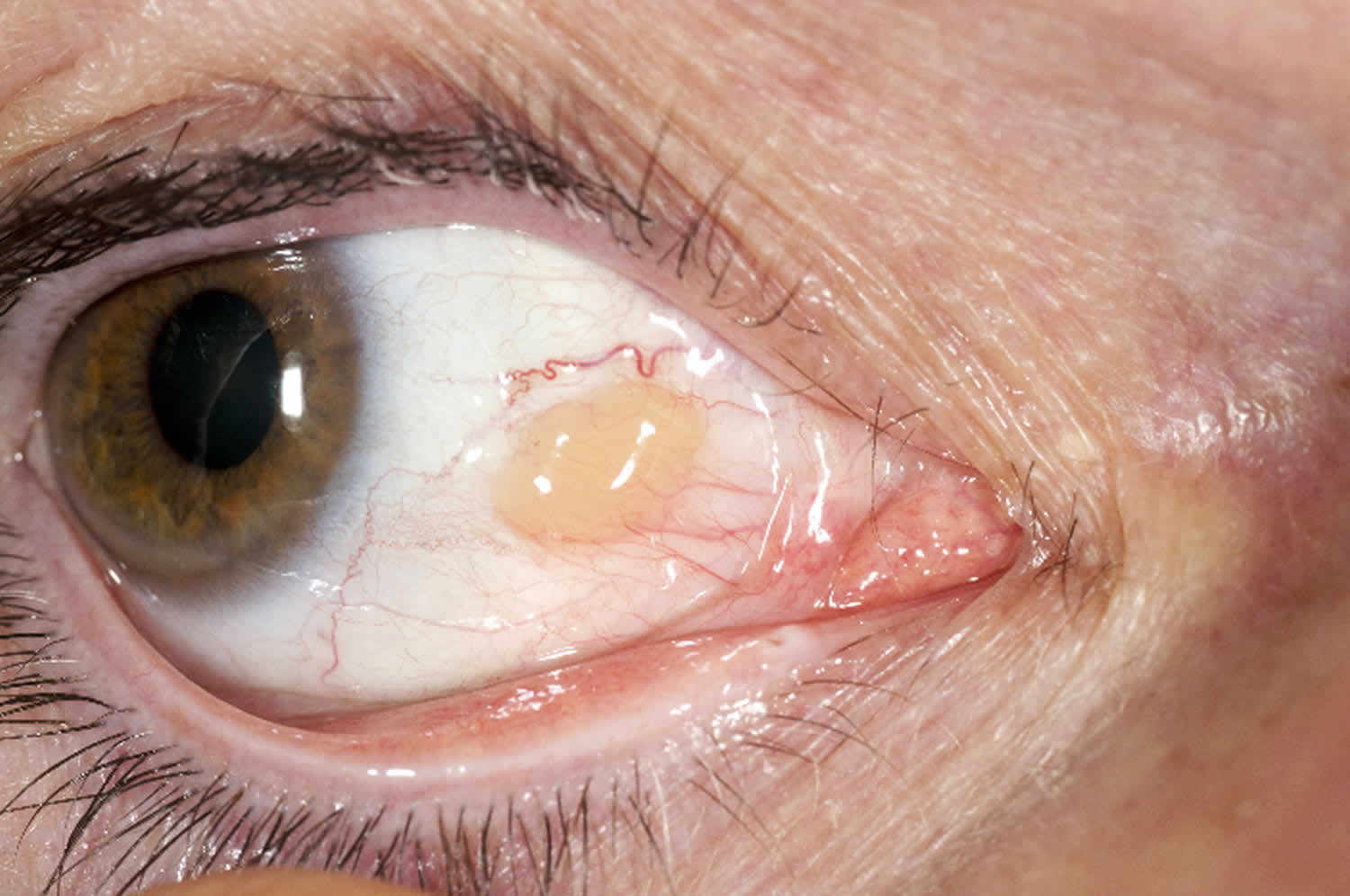 Pinguecula (Yellow Bump on Eyeball): Diagnosis, Causes & Treatment