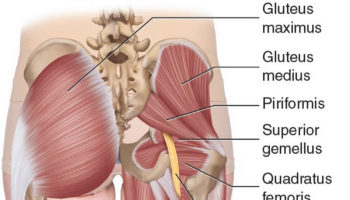 piriformis syndrome