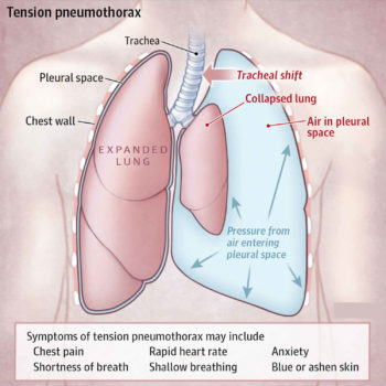 Hemothorax causes, signs, symptoms, diagnosis & hemothorax treatment