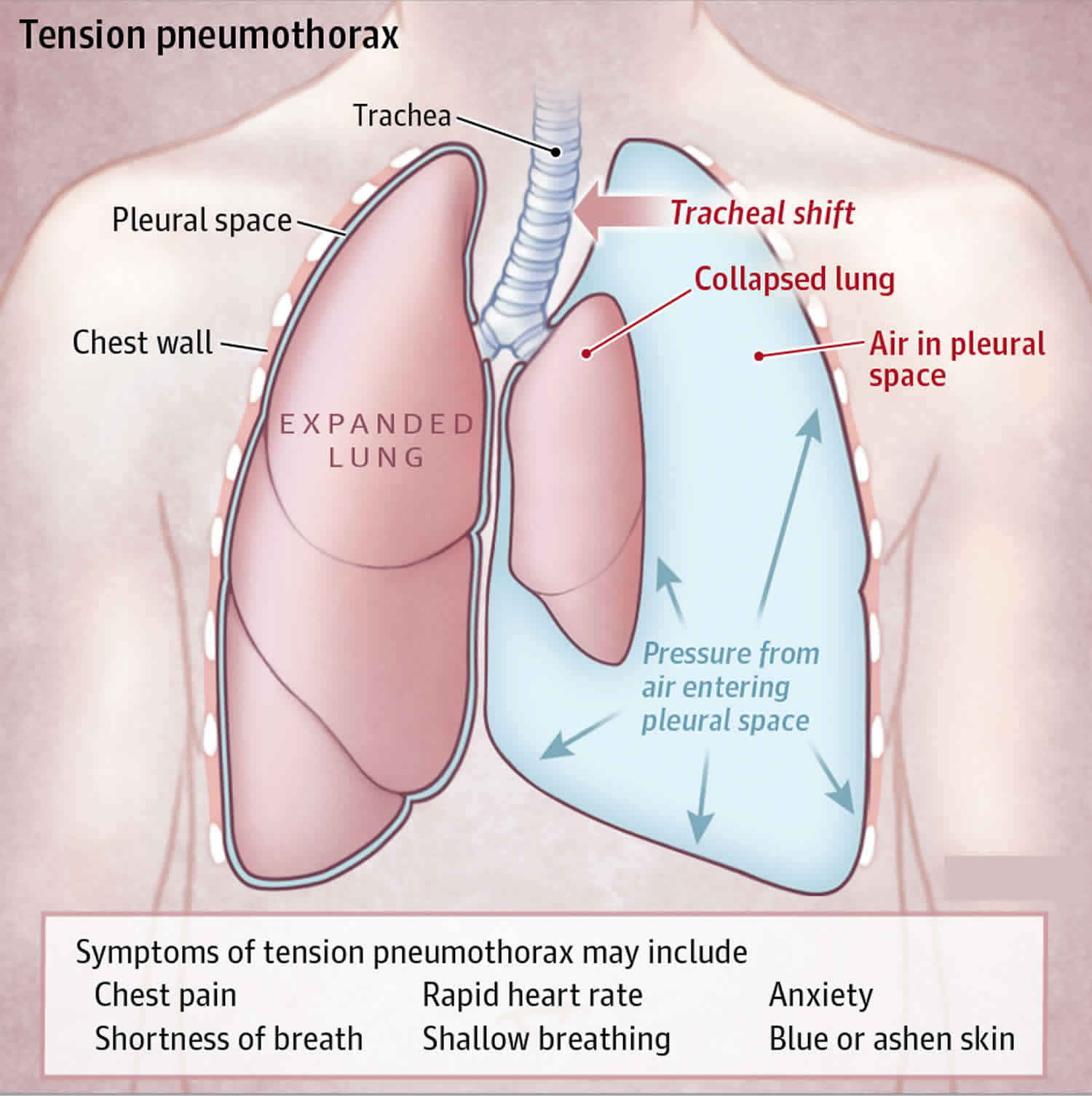 hemopneumothorax diagram