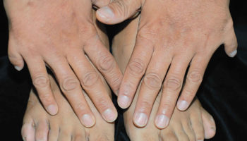 polydactyly