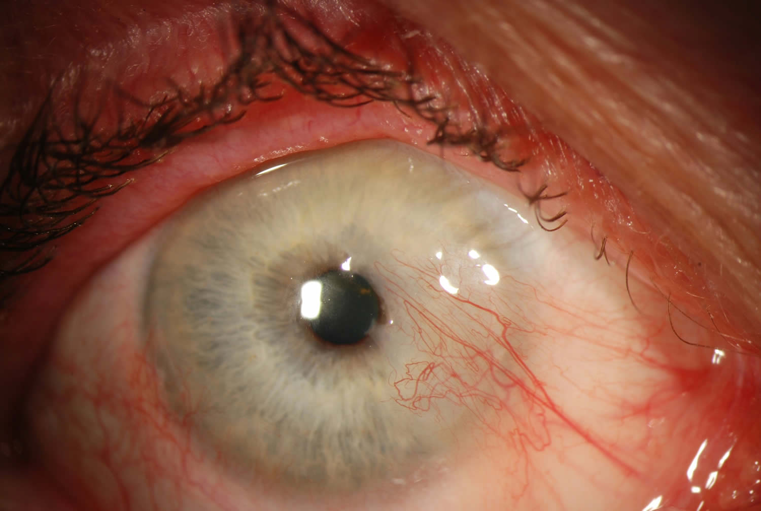 Pterygium eye