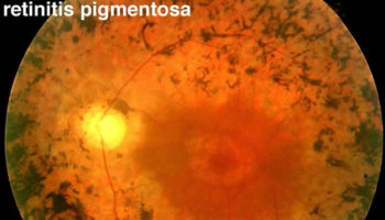 retinitis pigmentosa