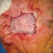 skin graft