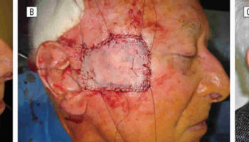 skin graft