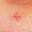 spider angioma