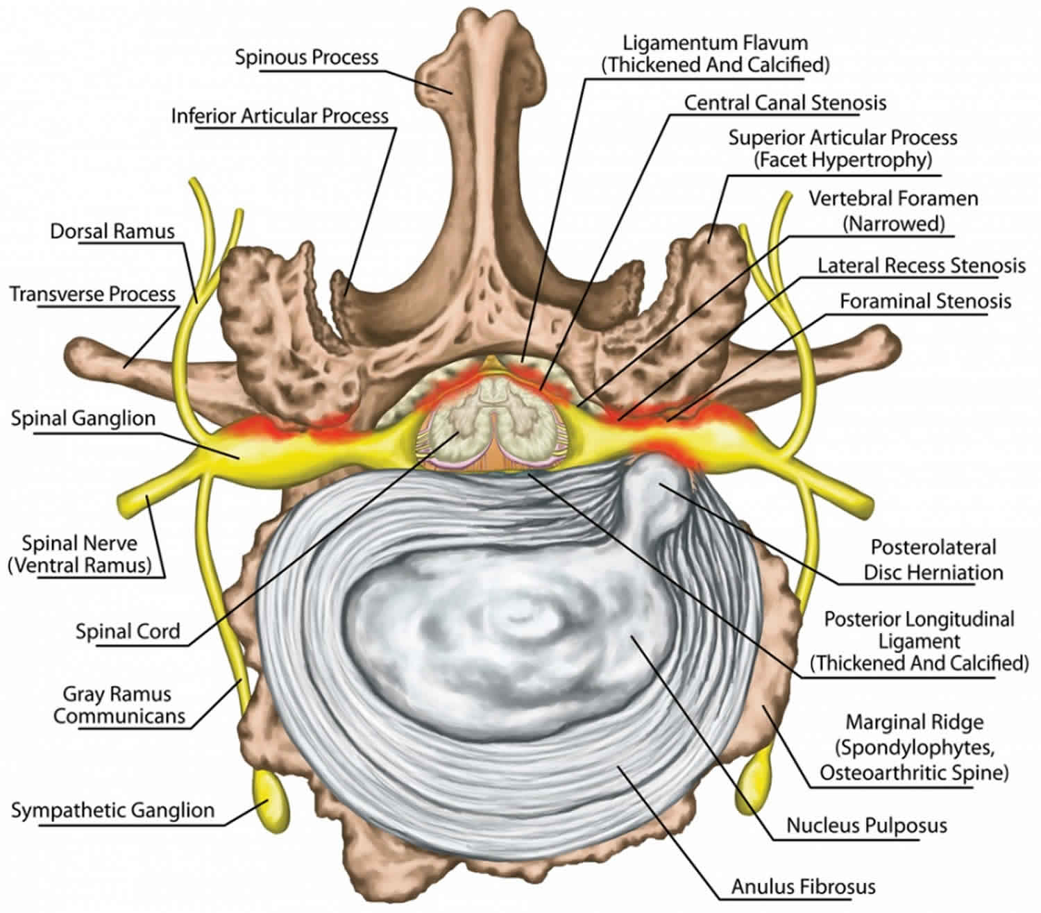 Spinal stenosis causes, symptoms, diagnosis, treatment and exercises