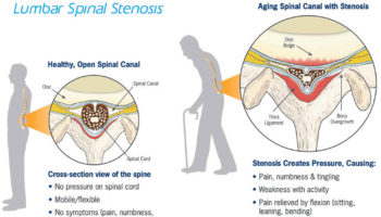 spinal stenosis