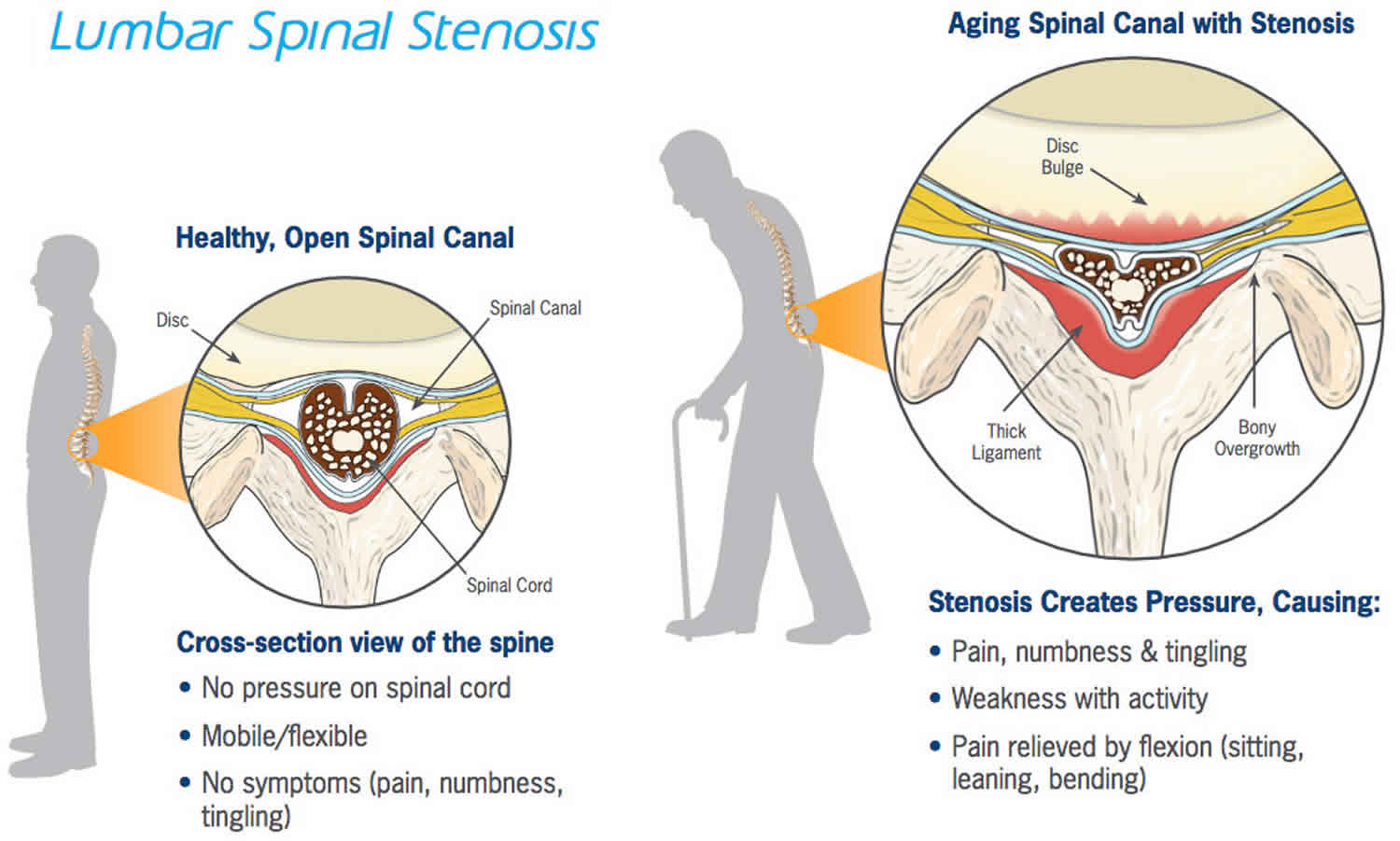 What Is The Medical Name For Spinal Stenosis