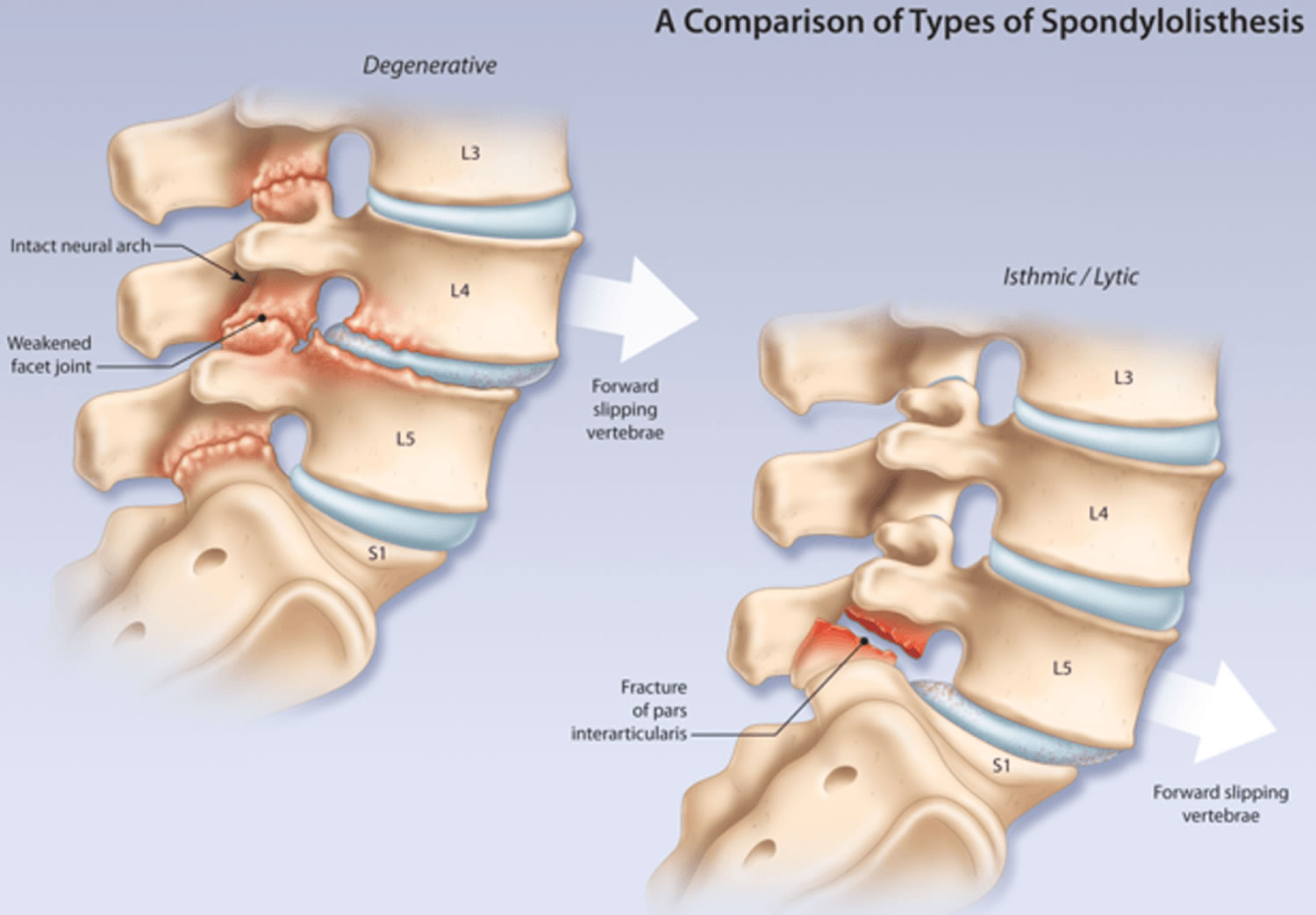 summary of guidelines for the treatment of lumbar spondylolisthesis