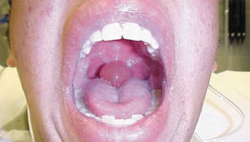 swollen uvula