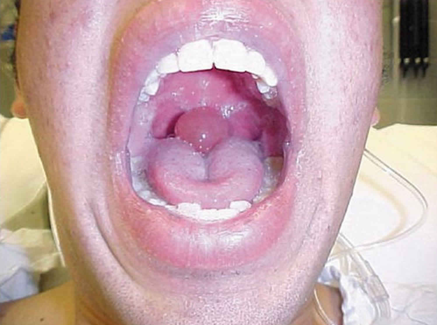 Swollen uvula or uvulitis causes, symptoms & swollen uvula treatment