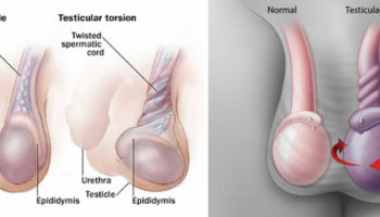 testicular torsion