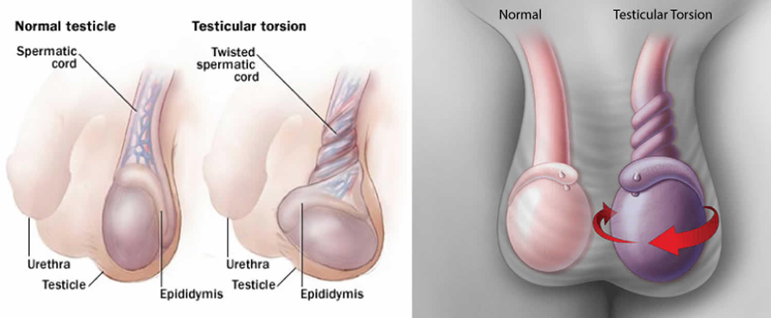 testicular-torsion-causes-signs-symptoms-diagnosis-treatment-surgery