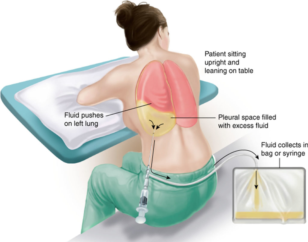 Thoracentesis indications, thoracentesis procedure, position