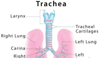 tracheomalacia