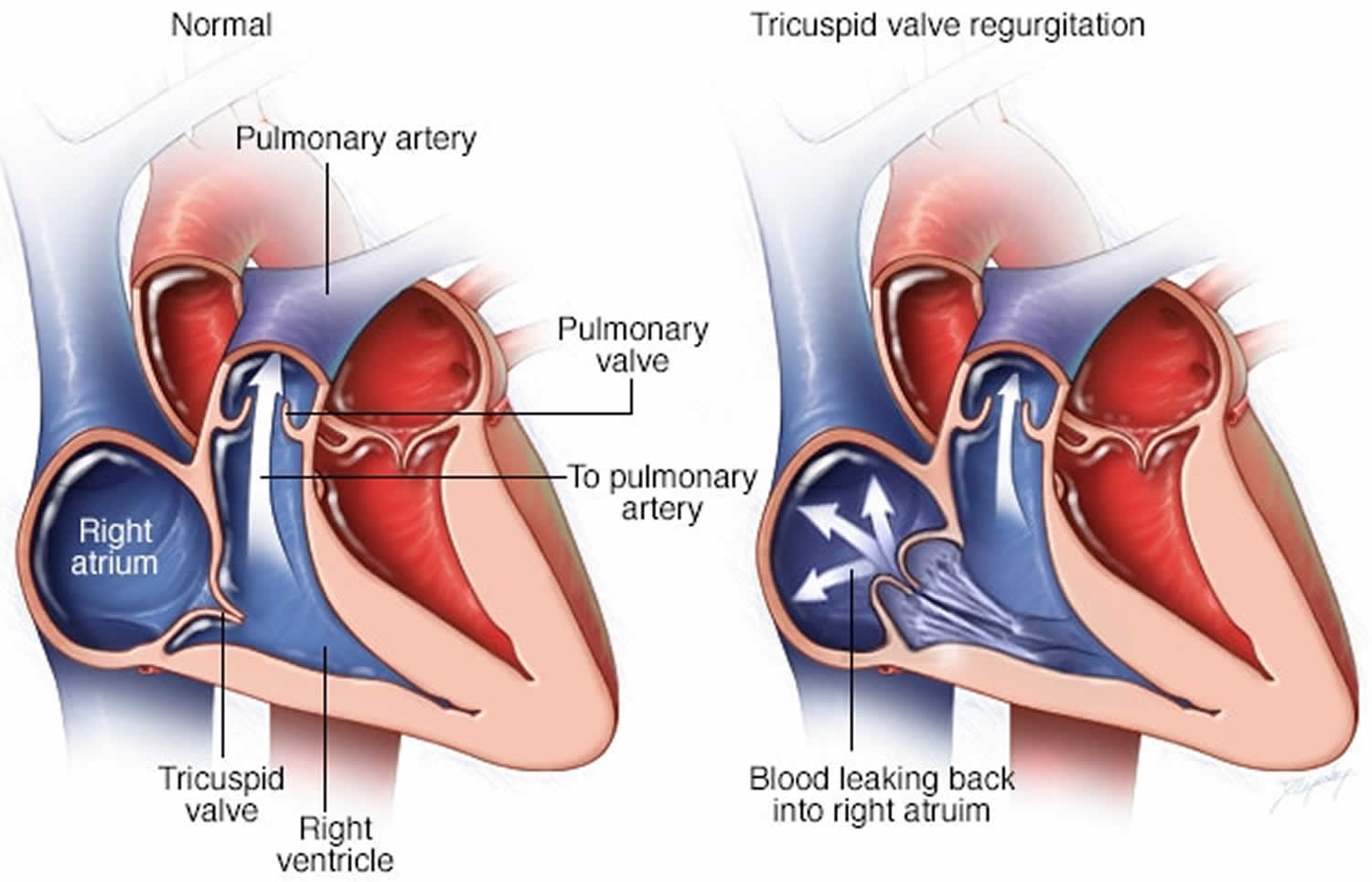 How Do You Treat Moderate Tricuspid Regurgitation