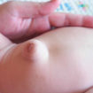 umbilical hernia