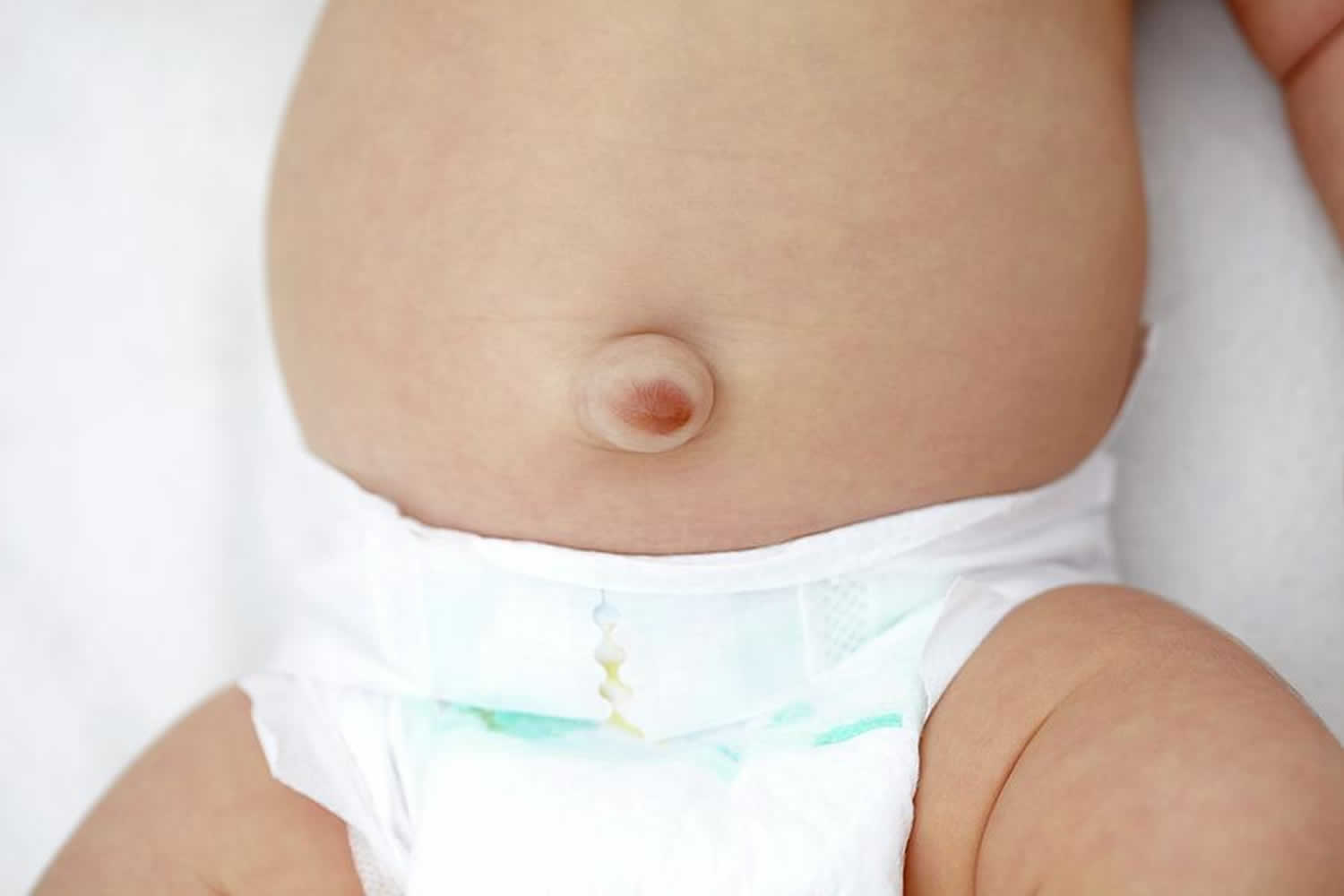 Understanding Umbilical Hernias in Infants and Children: Causes, Symptoms,  and Treatment, by Dr Paritosha Dalal