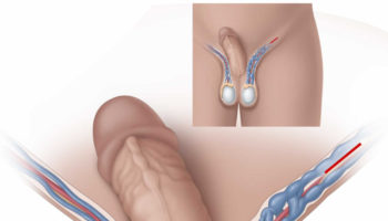 varicocele