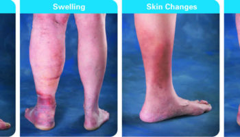 venous insufficiency