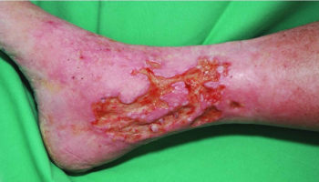 venous ulcer