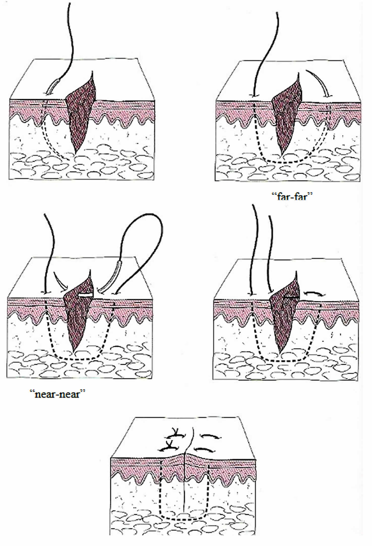 vertical mattress suture