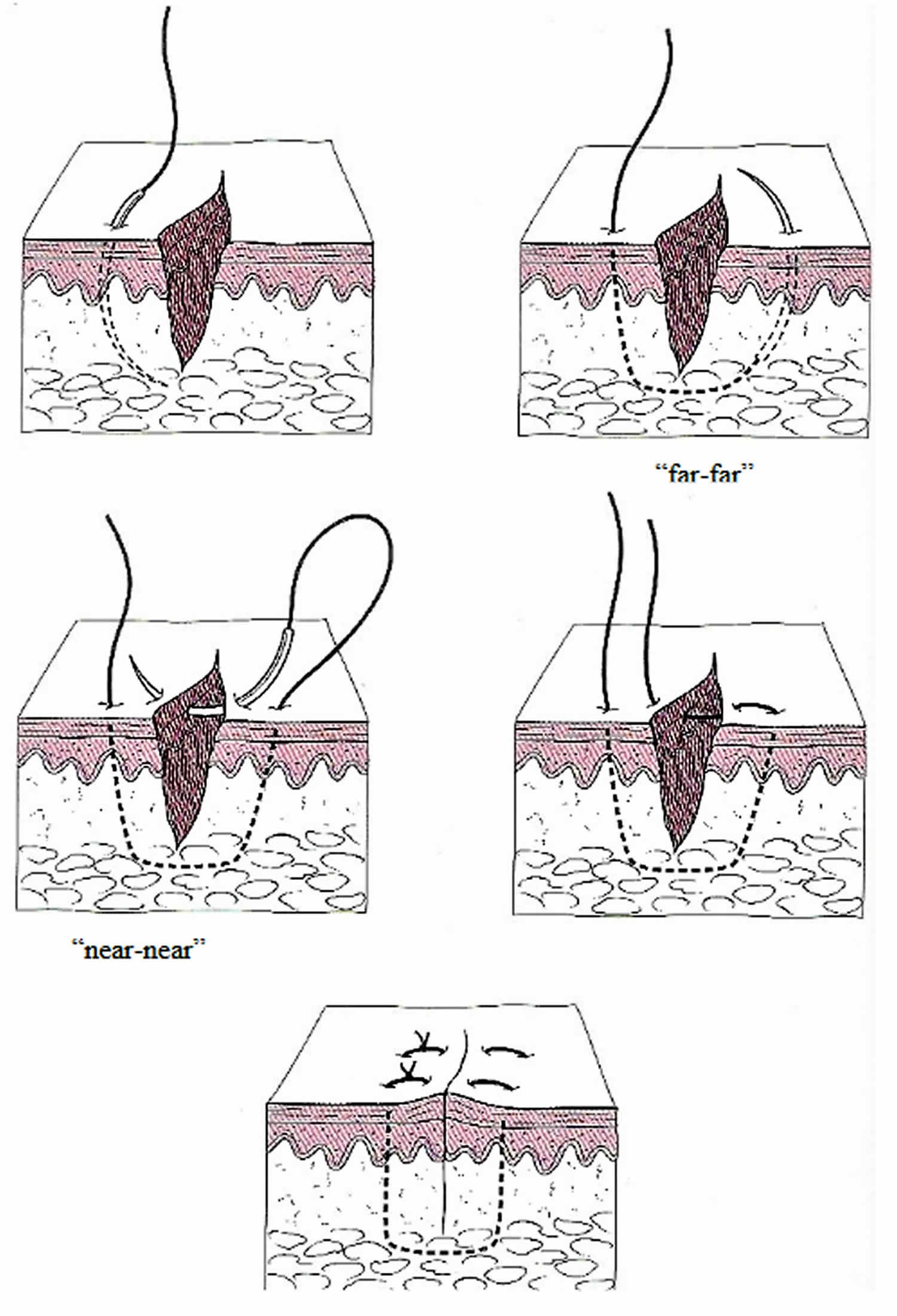 How To Mattress Suture at Robbie Case blog