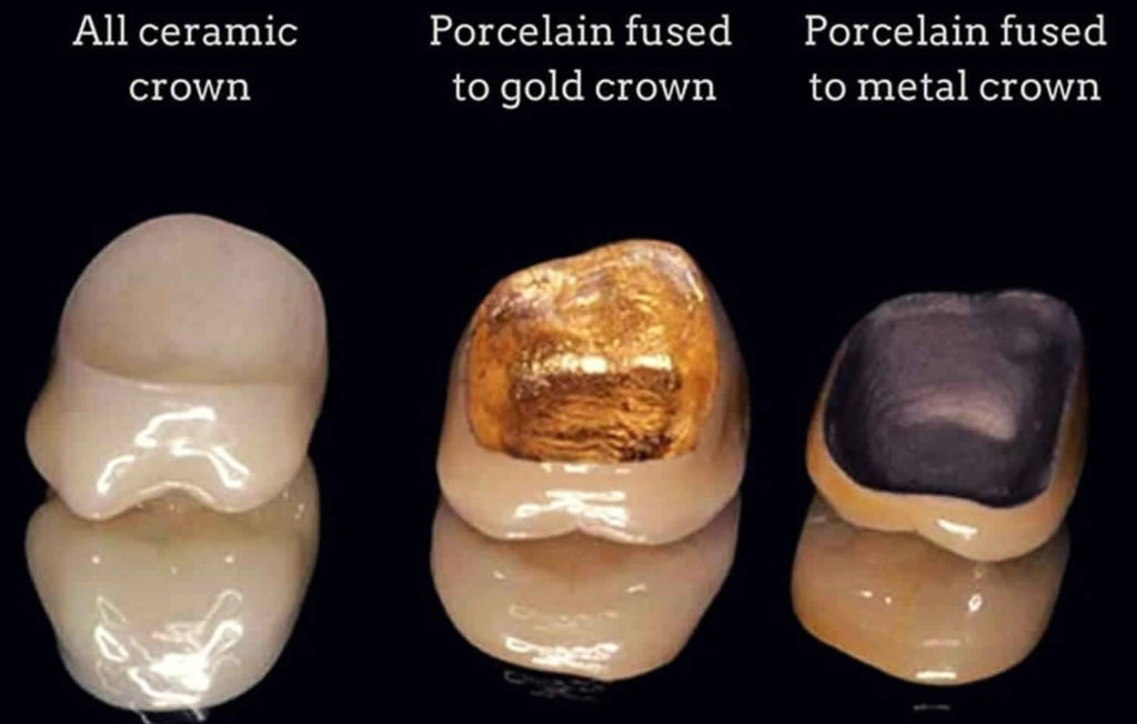 Dental Crown Procedure And Process What A Dental Crown Look Like