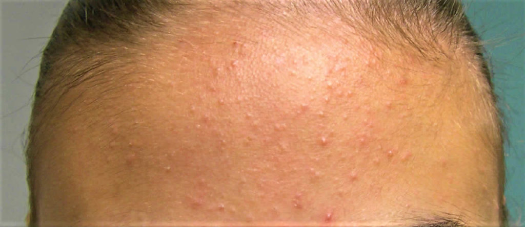 whiteheads-causes-find-out-how-to-get-rid-of-whiteheads