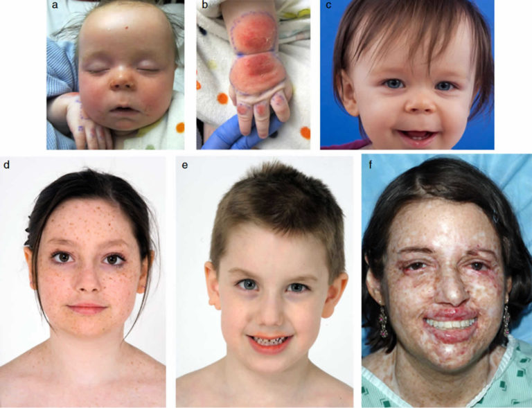 Xeroderma pigmentosum causes, signs, symptoms, diagnosis & treatment