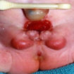 Bladder exstrophy