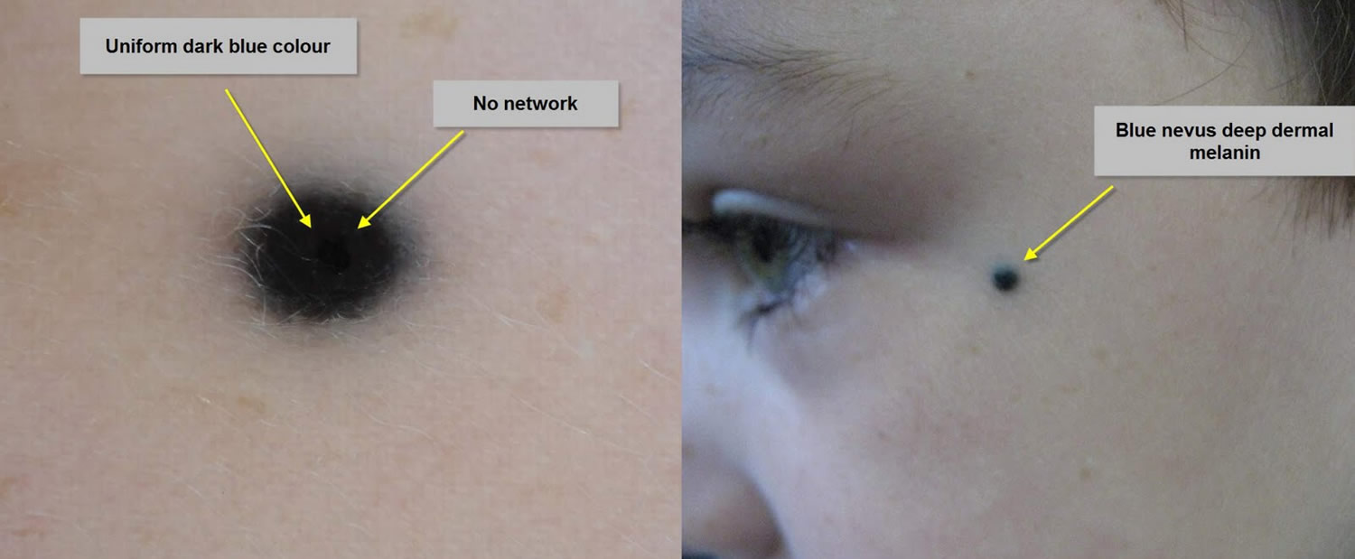 Junctional Nevus Removal