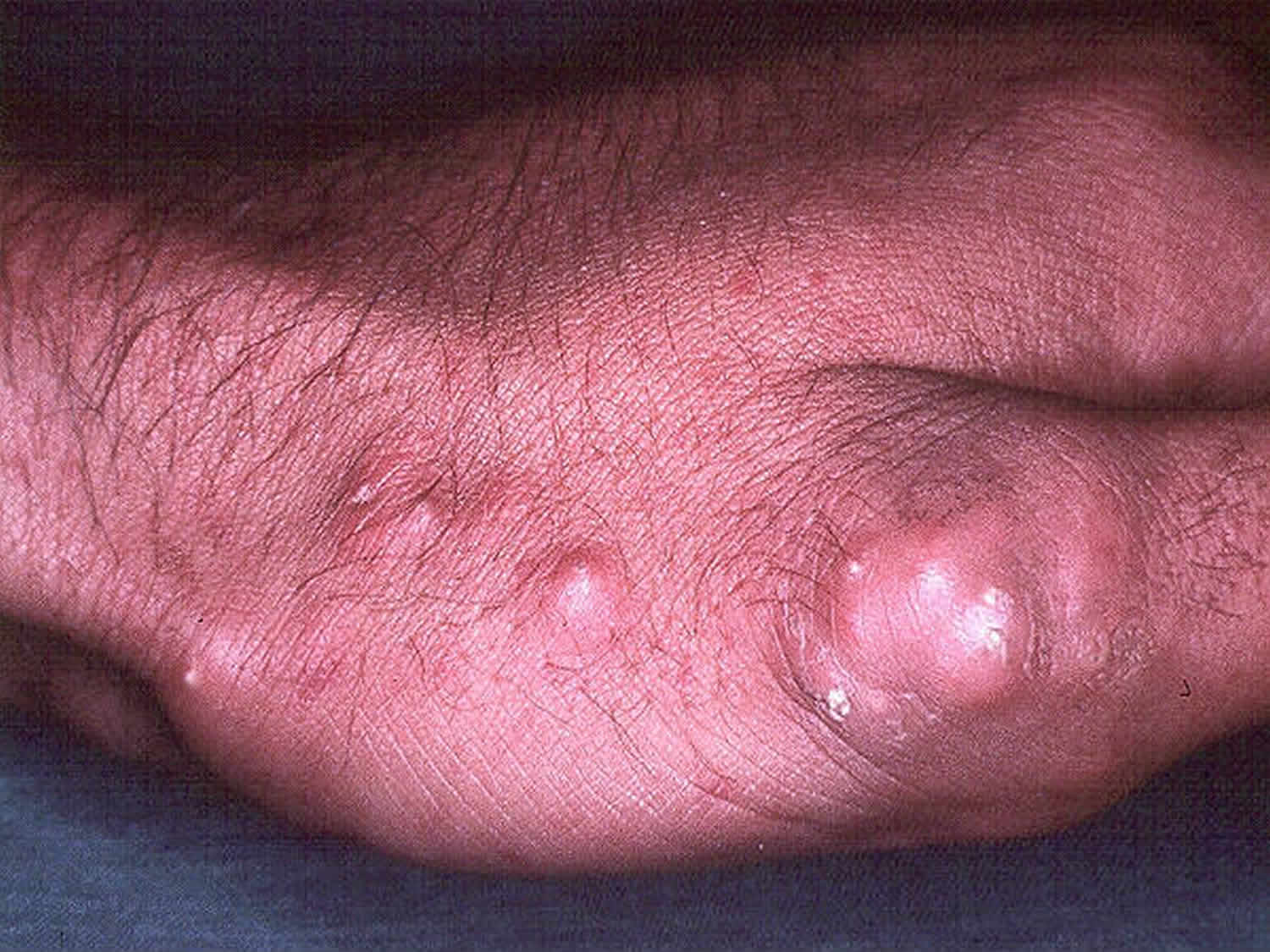 CREST syndrome