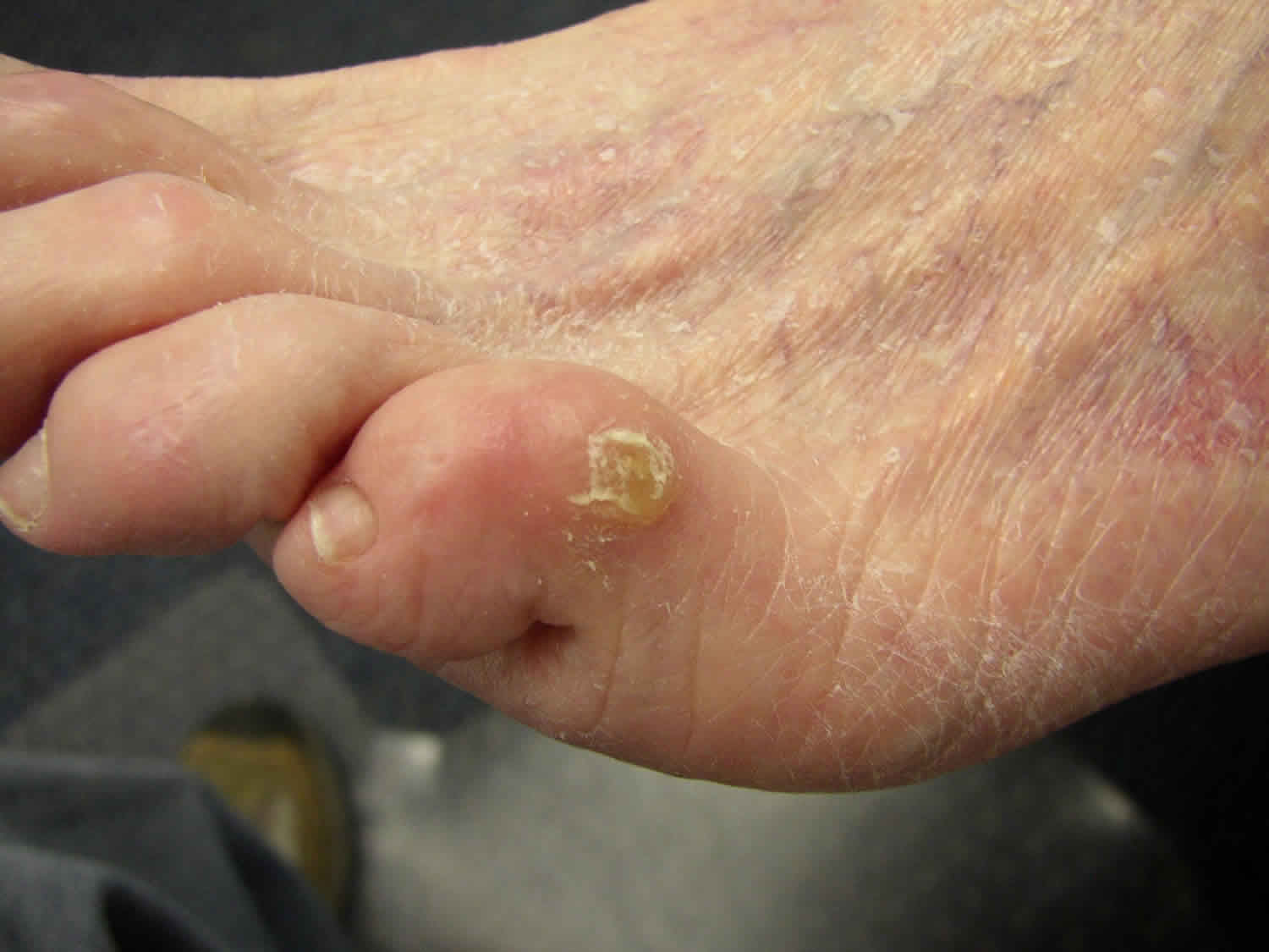 Corns and calluses on feet and learn how to get rid of 