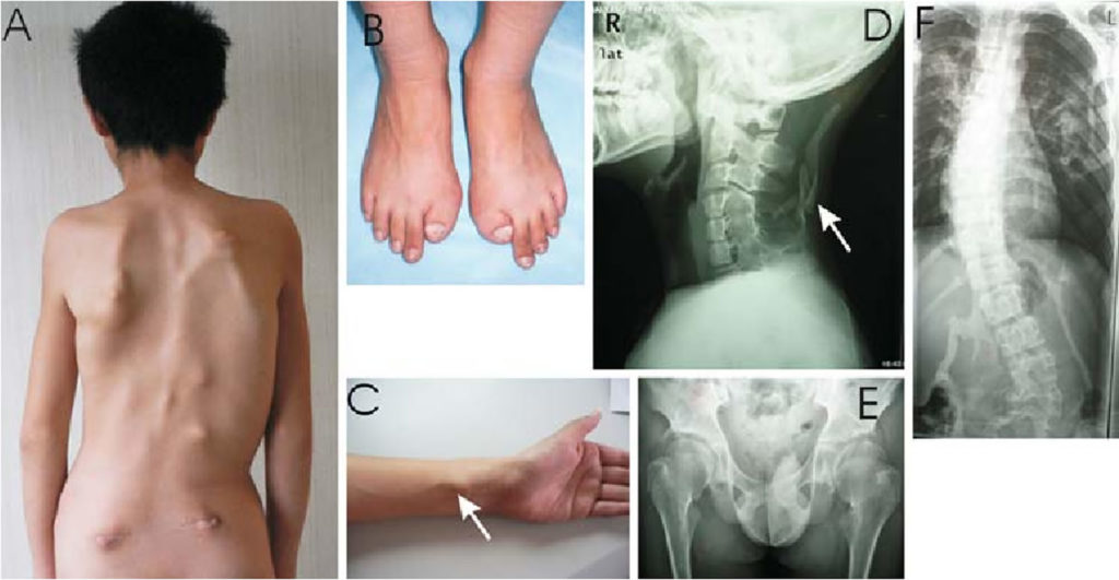 new research on fibrodysplasia ossificans progressiva