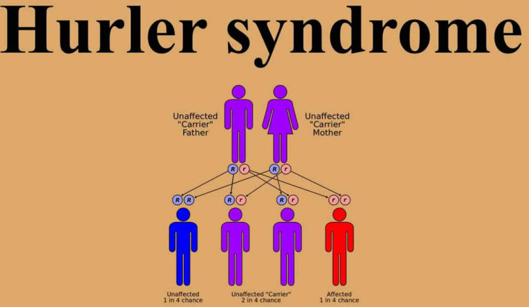 Hurler syndrome causes, symptoms, diagnosis, treatment